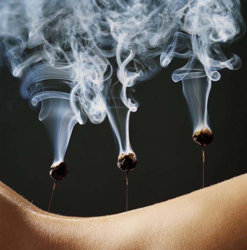 Utilisation de moxas aiguilles sur le dos en acupuncture